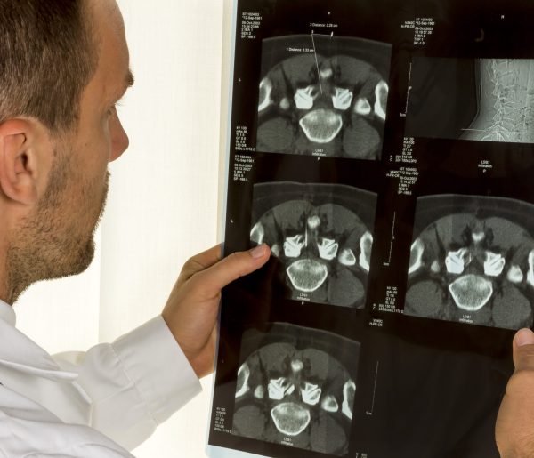 Doctor holding MRI scan of spinal disc